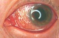 conjunctivitis